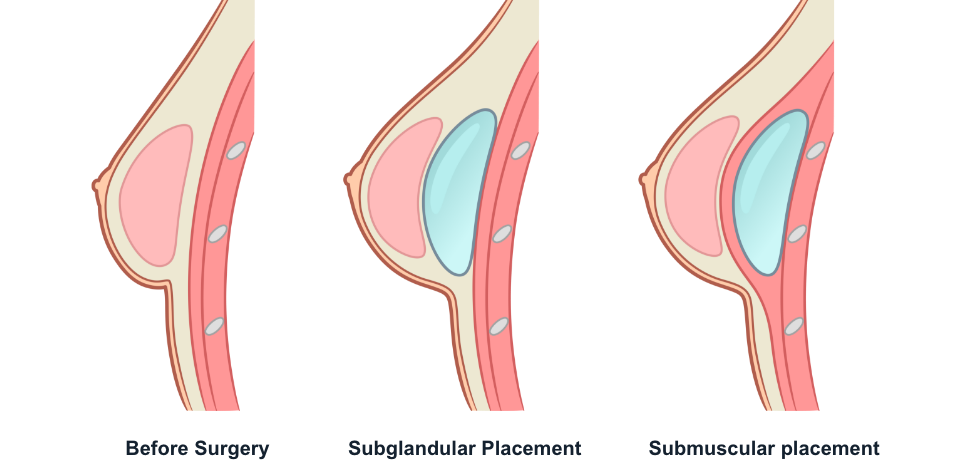 Implant location diagram