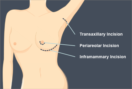 Incision location diagram