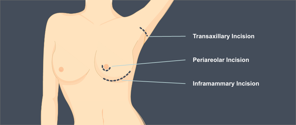 Incision location diagram