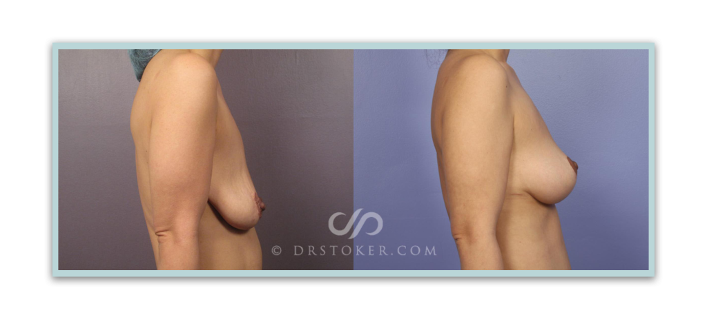 Before and after breast lift
