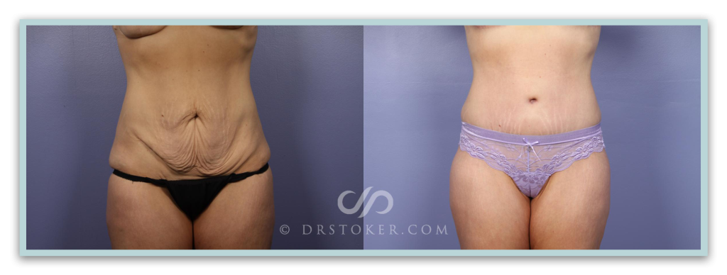 Before and after tummy tuck surgery