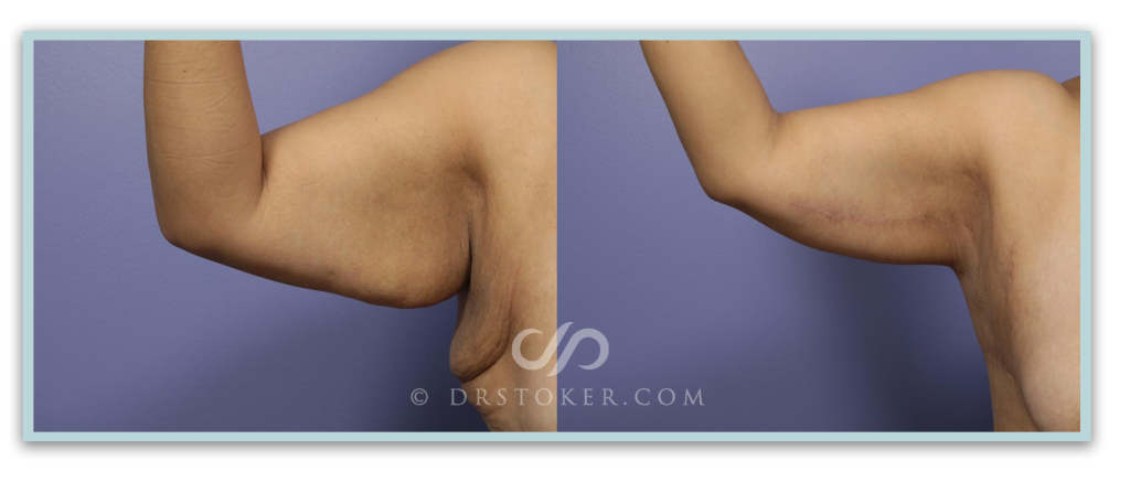 Before and after arm lift