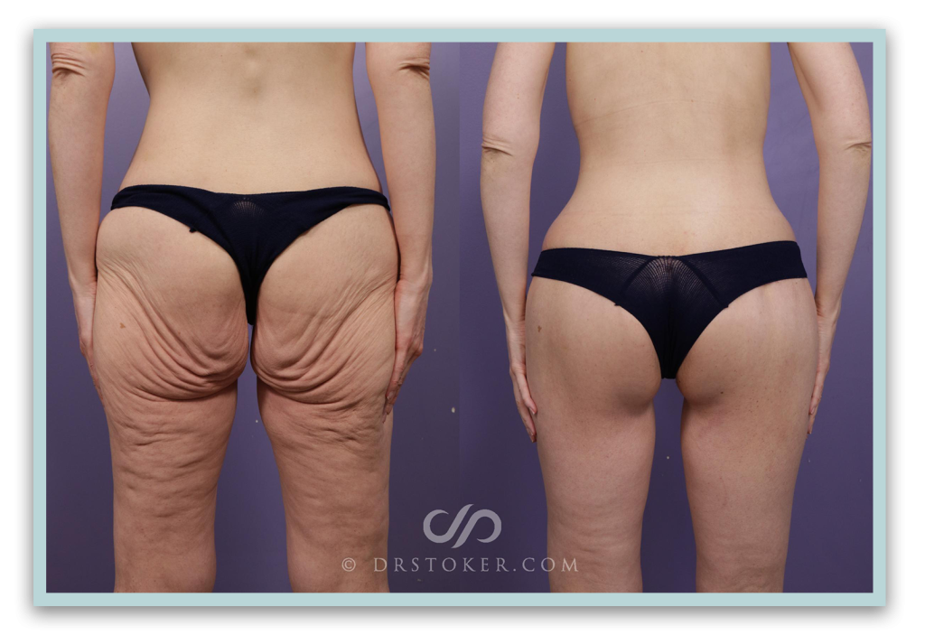 Before and after thigh lift