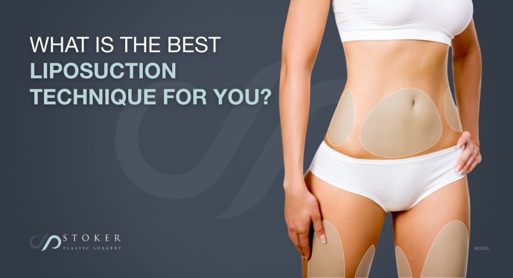 What is the best liposuction technique for you (model)