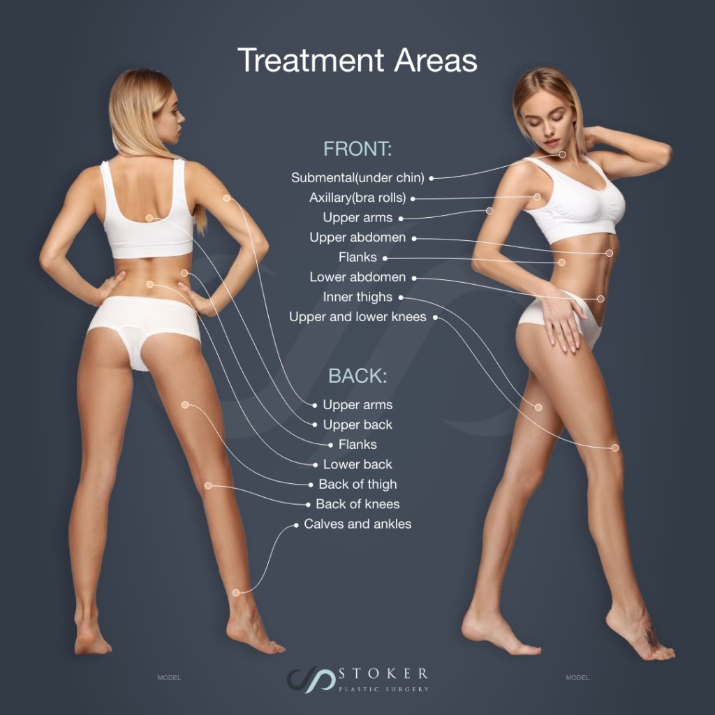 Liposuction treatment areas (model)