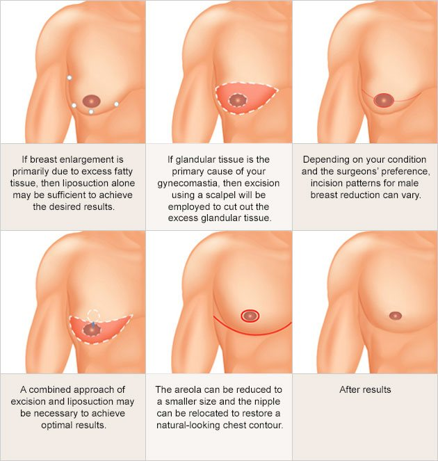 diagram of gynecomastia procedure in 6 stages