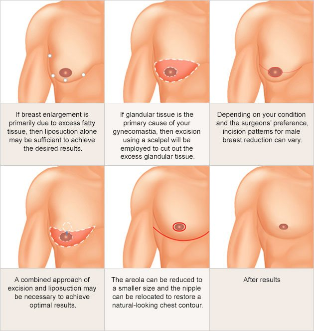 Puffy Nipples - Fat Nipples - Gynecomastia