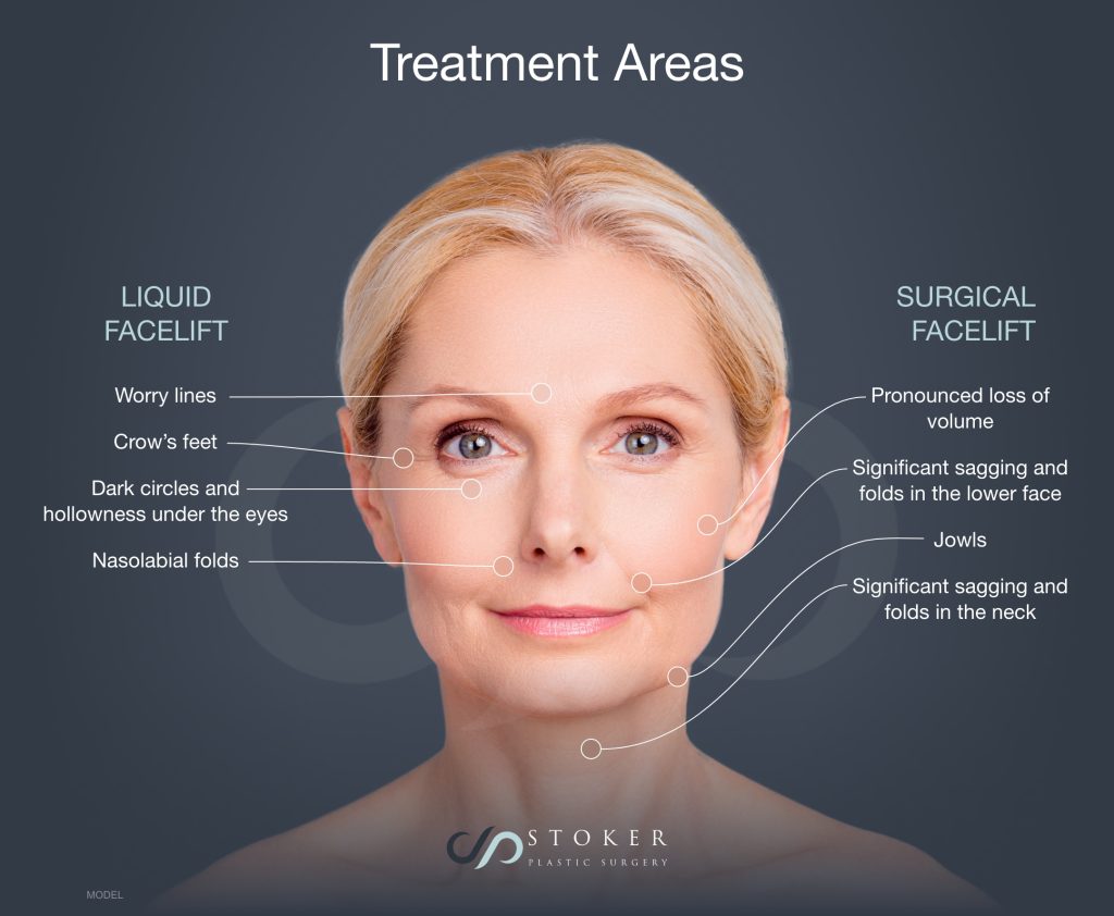 Treatment areas of liquid and surgical facelift. Smiling woman with lines to specific areas of her face (model)
