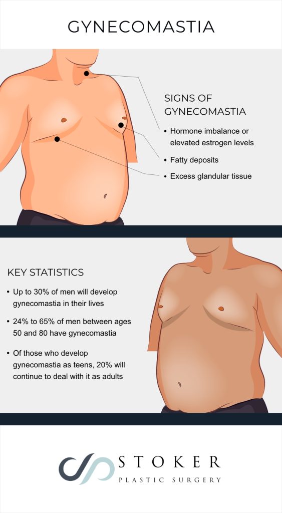 Inforgraphic showing the signs of gynecomastia and key statistics about the condition