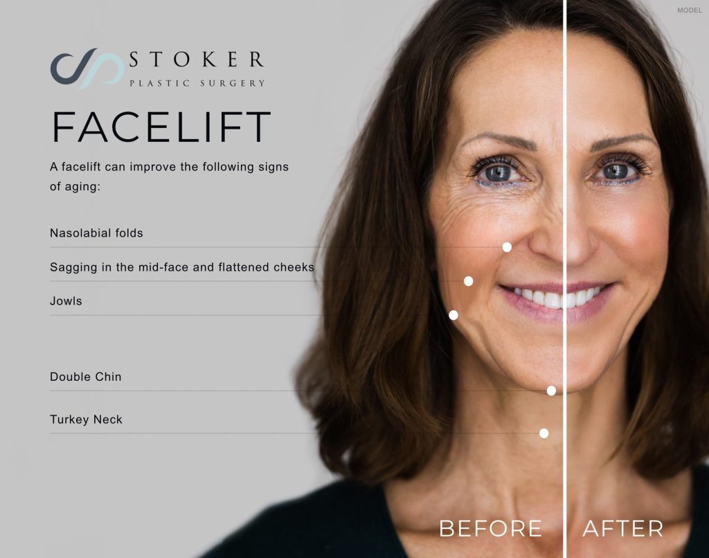 Infographic showcasing common signs of facial aging that can be improved with a facelift.