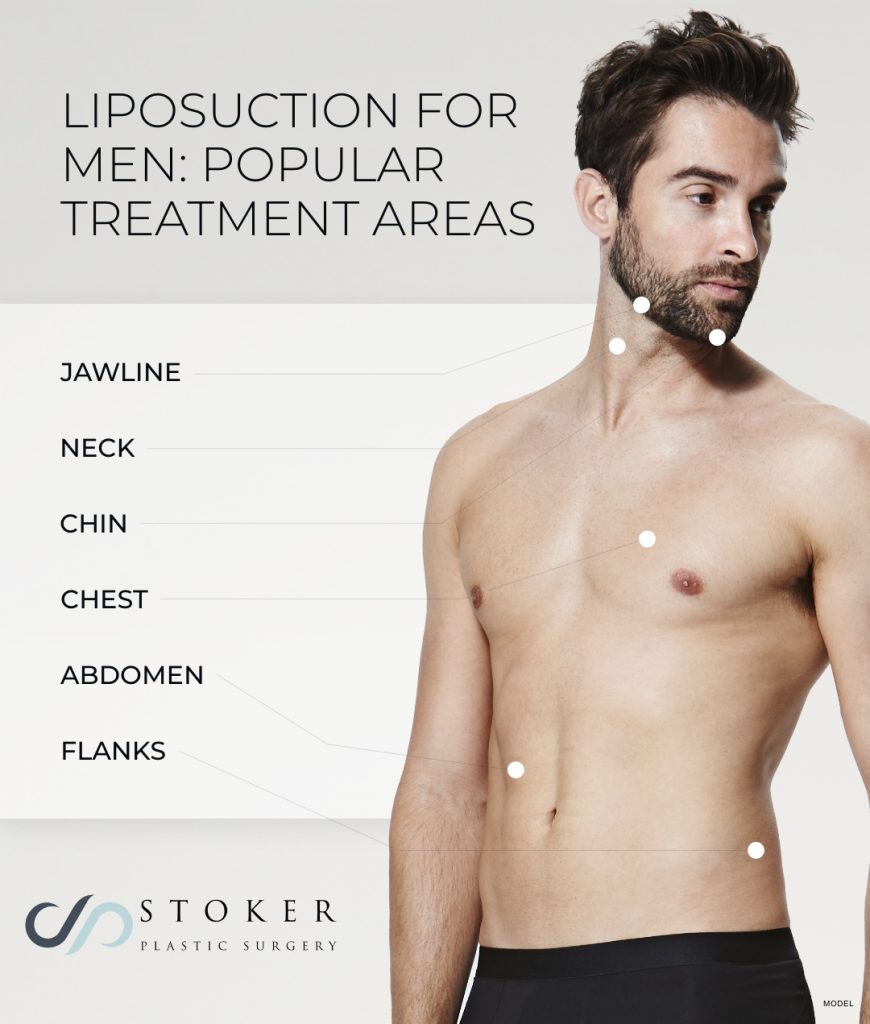 Infographic detailing different liposuction treatment areas for men including the jawline, neck, chin, chest, abdomen, and flanks
