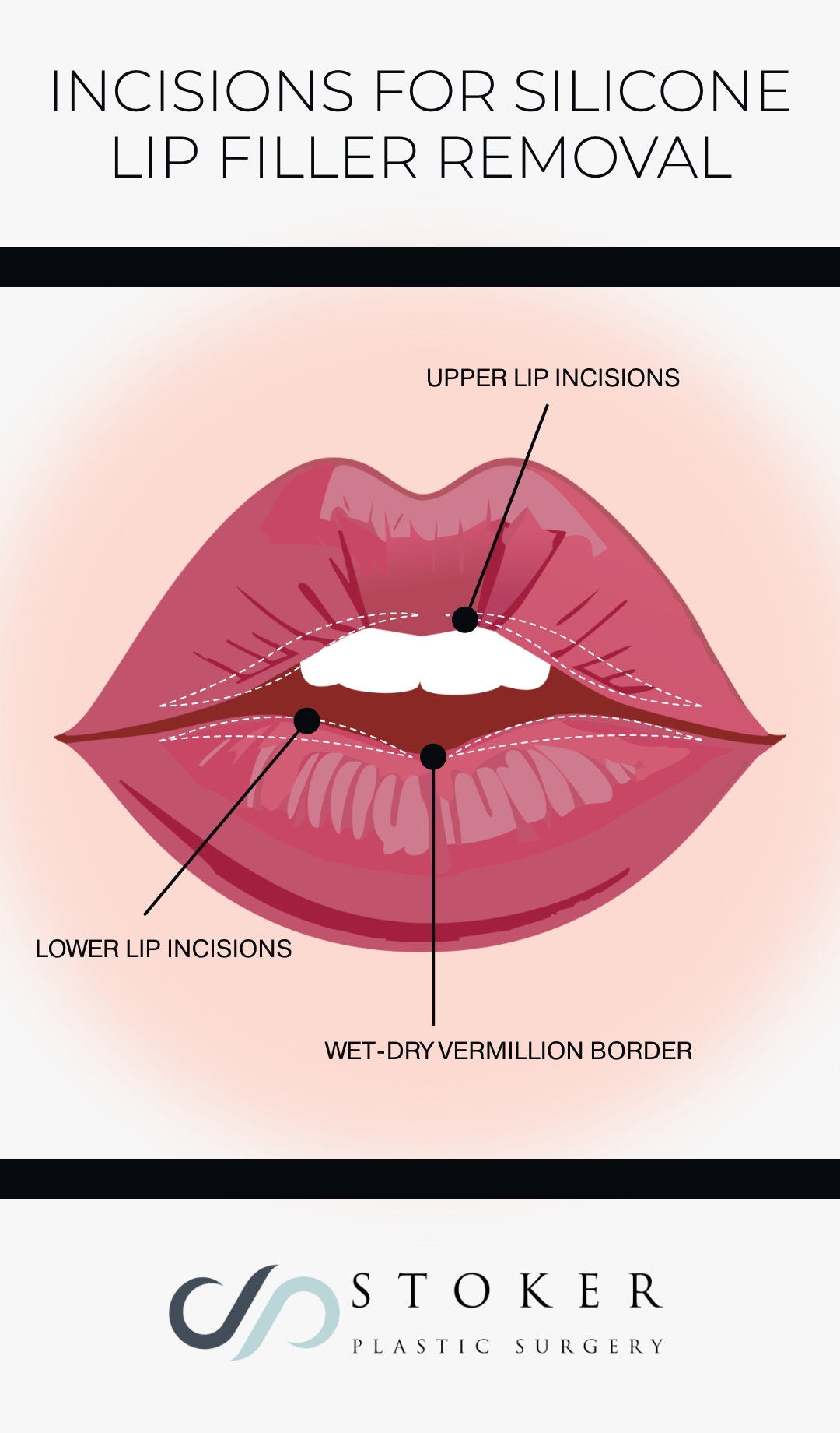 Infographic showcasing incision areas for silicone lip filler removal