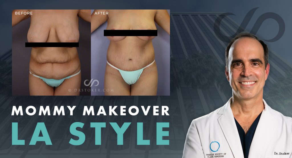 "Mommy Makeover LA Style" with a before and after mommy makeover results by Dr. Stoker