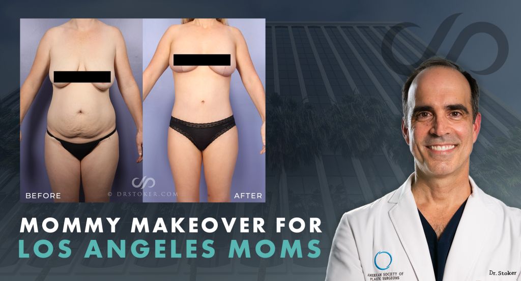 "Mommy Makeover for Los Angeles Moms" with a before and after mommy makeover results by Dr. Stoker