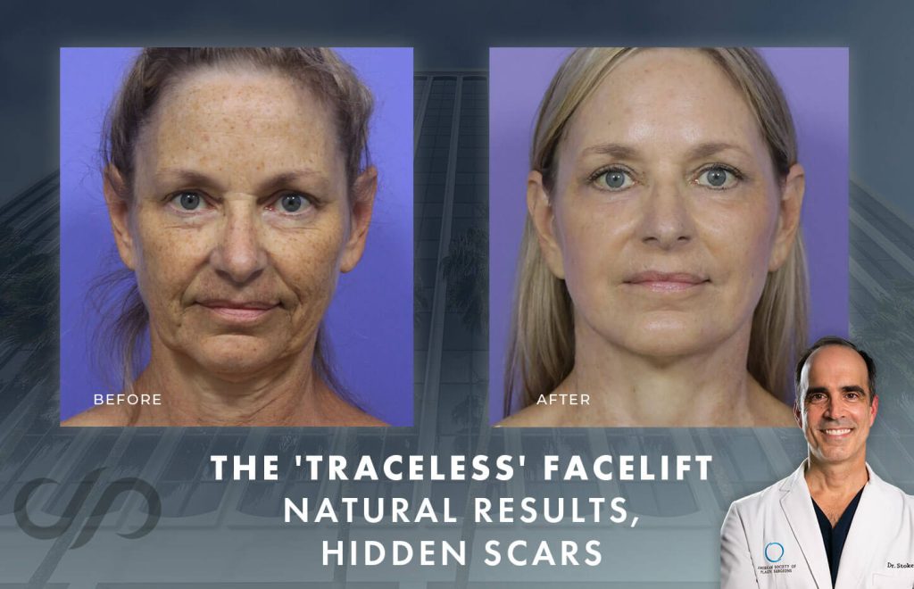 "The 'Traceless' Facelift. Natural Results, Hidden Scars" with real patient's image before and after a facelift procedure and an image of Dr. Stoker.