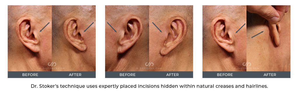 Before and after photos showing incision placement for facelift.