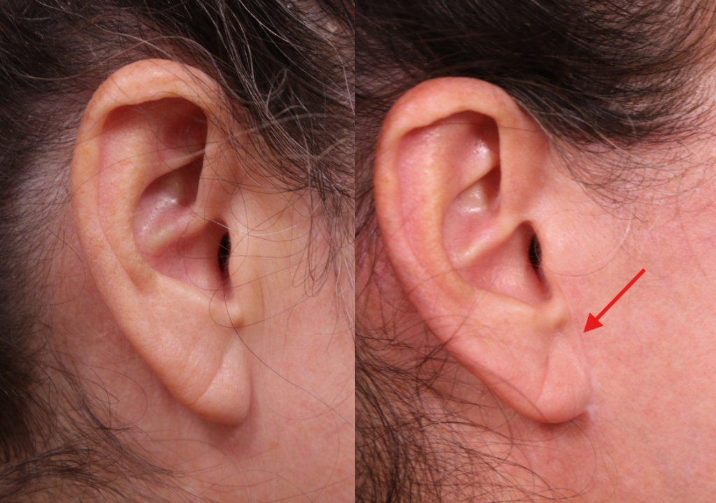 Traceless facelift before and after photos with arrow showing lack of scar