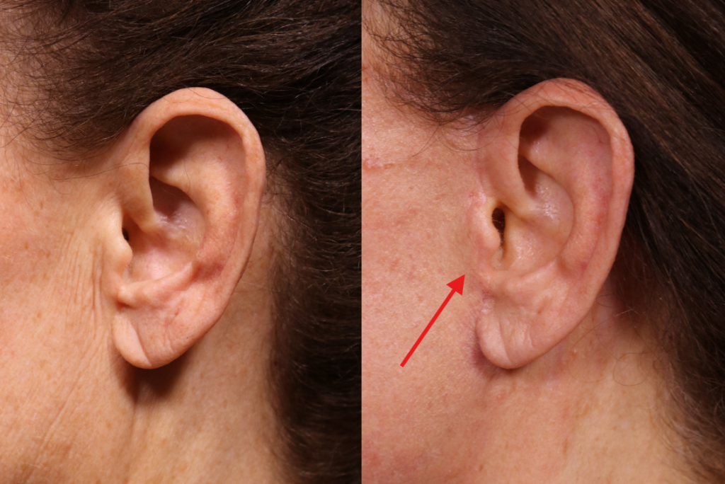 Traceless facelift before and after photos with arrow showing lack of scar