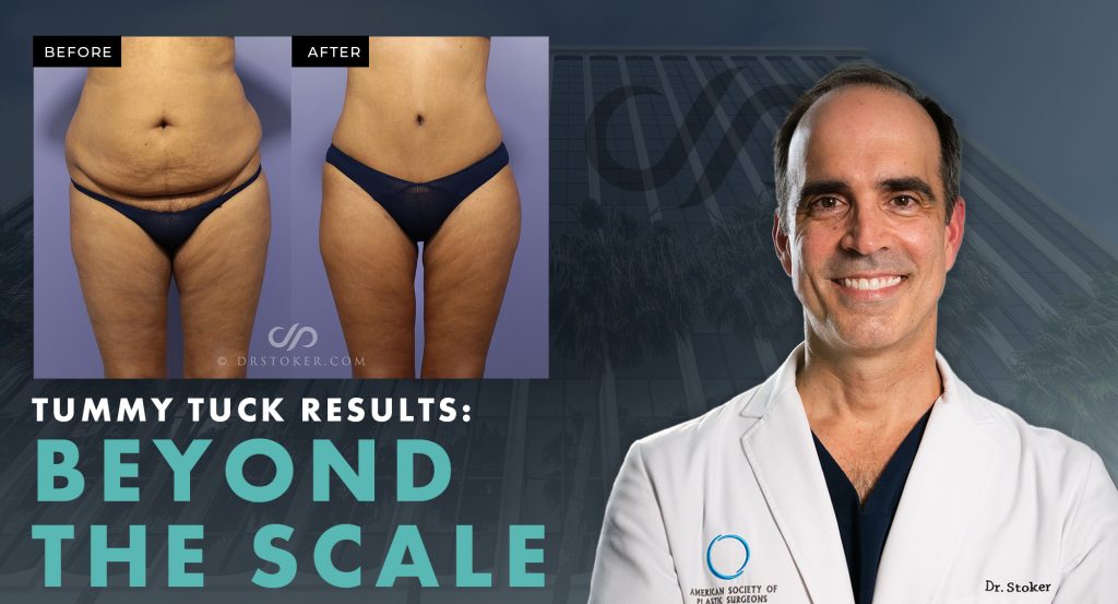 Tummy Tuck Results Beyond the Scale with real patient result image and Dr. Stoker.