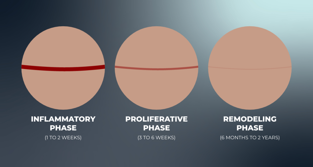 Illustration showing scar healing phases