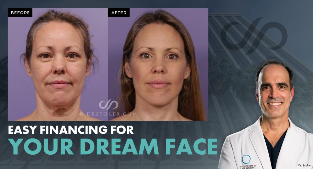 "Easy financing for your dream face" with real patient's B&A image and Dr. Stoker.