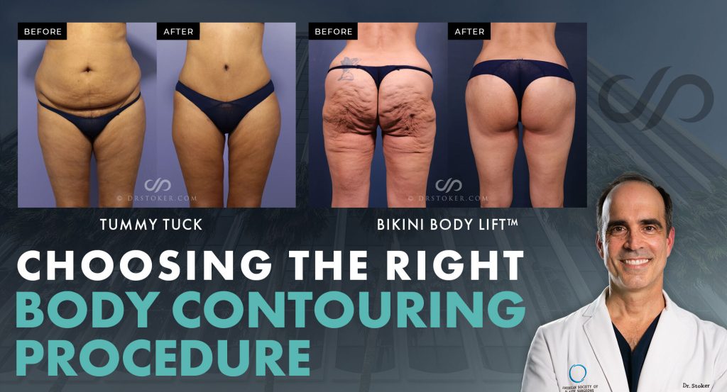 "Choosing the right body contouring procedure" with real patient B&A image and Dr. Stoker.