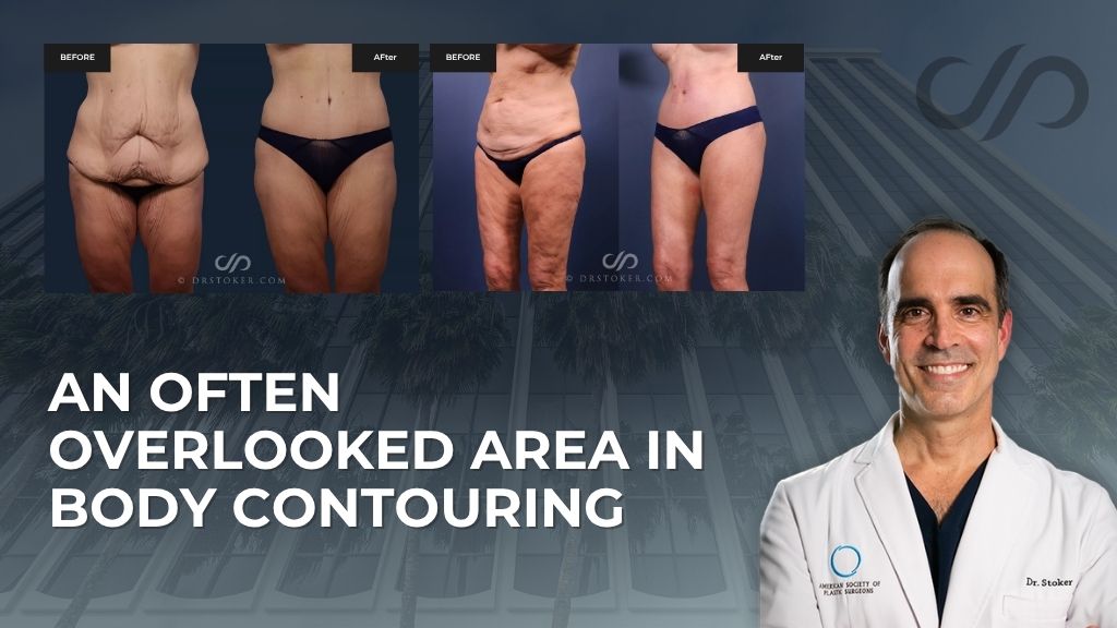 Before-and-after body contouring images with Dr. Stoker on the right. Text reads, “An often overlooked area in body contouring.”