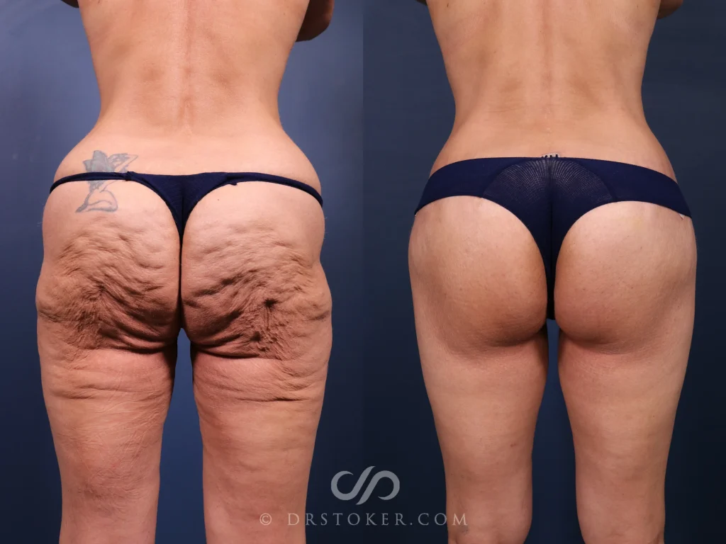 Bikini body lift before and after photos