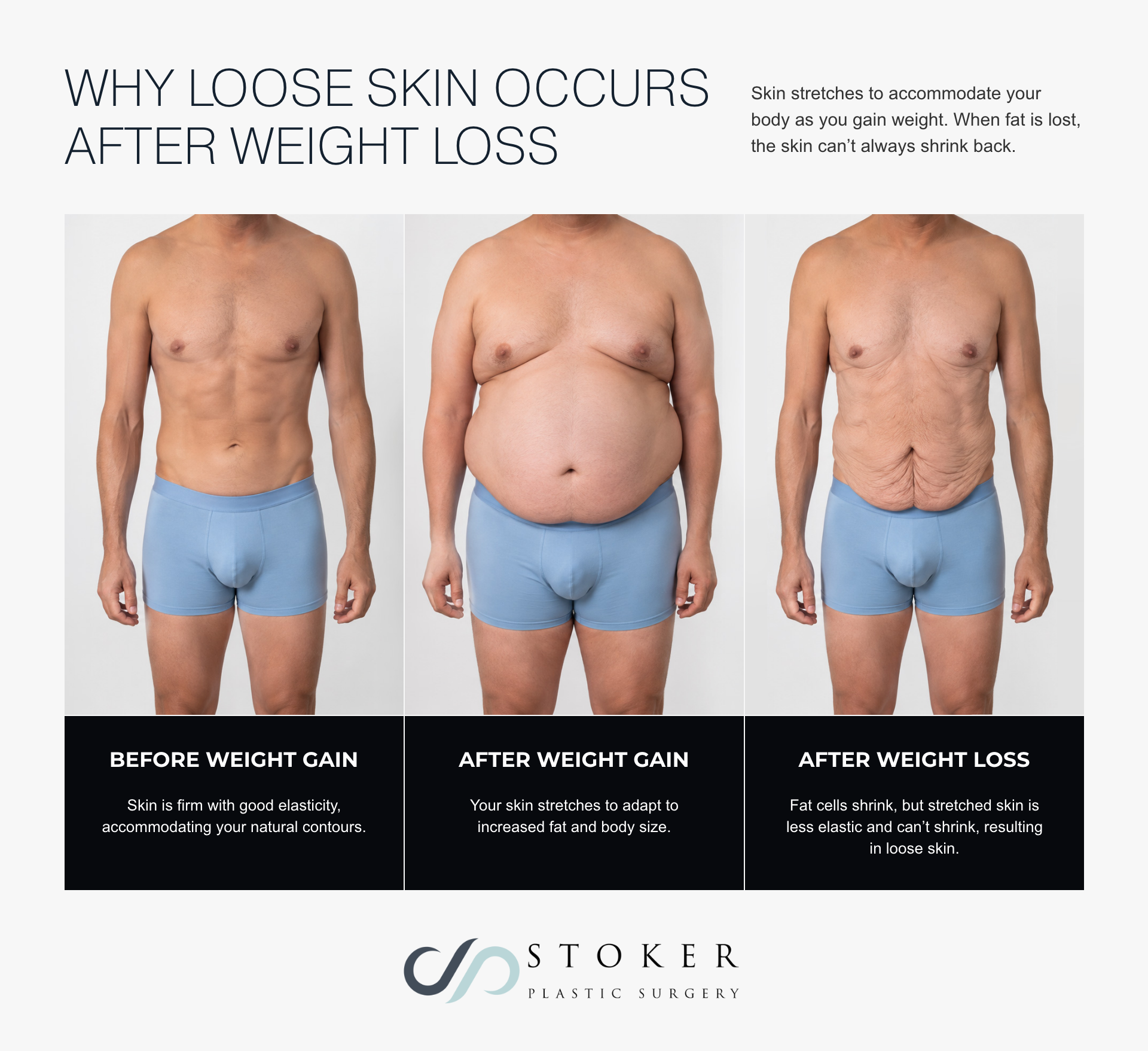 Infographic showing a man’s abdomen before weight gain, after weight gain, and after weight loss, with loose skin.