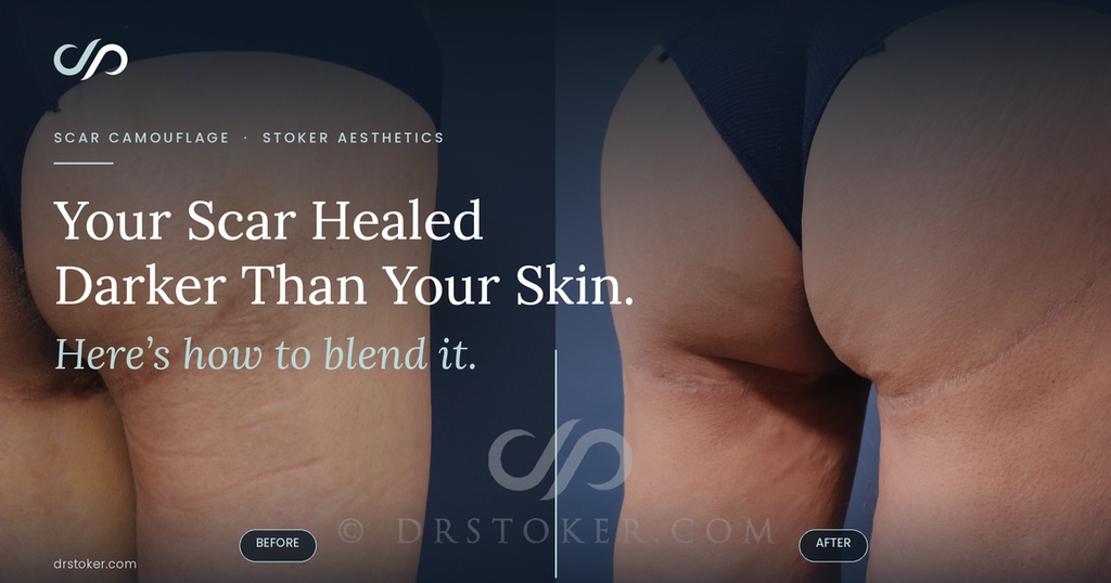 Before and after photos of scar camouflage treatment on a dark, discolored scar on the thigh and buttock, performed at Stoker Aesthetics in Los Angeles.