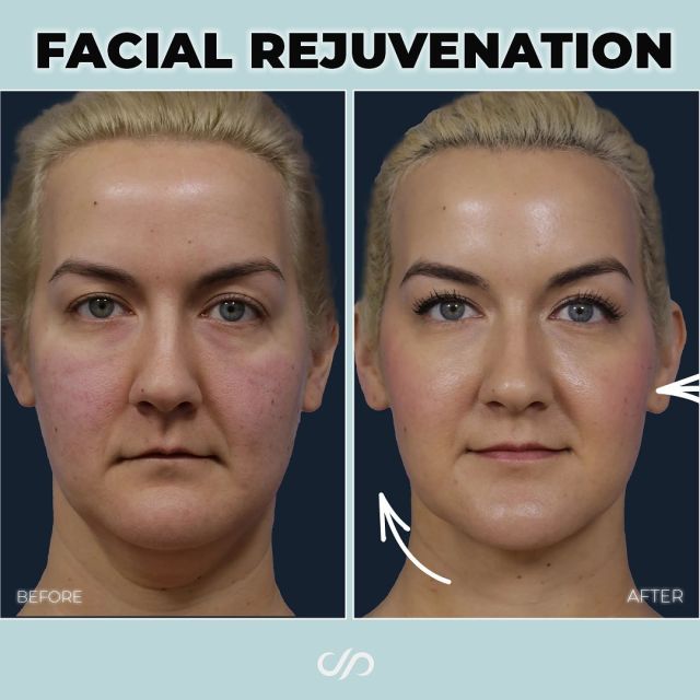 Facial Rejuvenation 👩🌟 // #beforeandafter 

Procedures Performed ✨
✅Buccal Fat Reduction
✅Neck Liposuction
✅CO2 Laser

👉This patient had excess subcutaneous fat mainly around the cheeks and neck, resulting in a less defined, rounded facial appearance with a double chin. Moreover, signs of sun damage like wrinkles and skin imperfections, likely from prolonged sun exposure, were visible.

🪄We removed the buccal fat pads from her cheeks during the procedure to improve facial shape and contour. We also performed liposuction on her neck to reduce the double chin's appearance. This led to a slimmer facial profile with less fullness in the cheeks. To address wrinkles and sun damage, we employed CO2 laser treatment to diminish wrinkles and redness on her cheeks.

Visit our website, drstoker.com, and learn more about our facial rejuvenation procedures. Also, check out our YouTube channel to see full-length, in-depth videos! 

BOOK NOW | In-office or virtual appointments by sending your name, number, and email to the DM.

📲 CALL US | questions regarding treatment: (310) 300-1779

🛍 SHOP SKINCARE | Link in bio 🔗 

COMMENT BELOW 🔽
.
.
.
.
#tracelessfacelift #facelift #necklift #skincare #cheeklift #lowerfacelift #laserskinresurfacing #blepharoplasty #upperbleph #trending #eyelidsurgery  #facialrejuvenation #chinaugmentation #skinrejuvenation #skintightening  #cosmeticsurgery #wrinkles  #surgery #rejuvenation #skin #plasticsurgeon #transformation #plasticsurgery