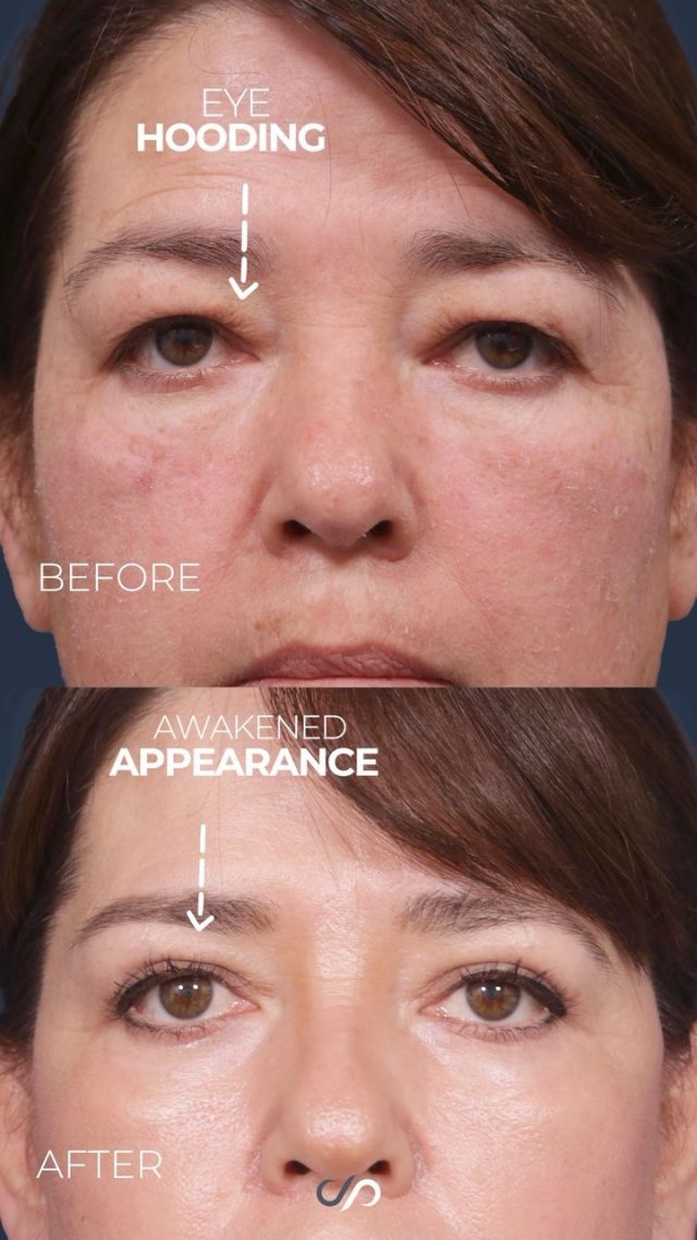 Upper & Lower Eyelid Lift w/ CO2 Laser 😍✨// #eyelidlift 

POST-OP RESULTS 👇 
👁️ Enhanced Eye Shape
👁️ Eliminated Puffiness
👁️ Improved Skin Texture

🌹Let us show you a remarkable three-month post-op transformation of a 54-year-old woman who underwent upper and lower eyelid surgery combined with fractional laser resurfacing. Check out how the light beautifully accentuates her striking brown eyes, a stark contrast to her previous appearance. Previously, she had a tired, somewhat puffy look with wrinkling and crepiness in the skin beneath her eyes.

✨Our procedures successfully addressed her concerns by eliminating excess skin and fat, resulting in a more rounded and almond-shaped eye contour, which is truly stunning. We also effectively removed the under-eye puffiness and treated the skin’s texture and crepiness with CO2 laser. The outcome is undeniably gorgeous, rejuvenating her appearance and leaving her with a vibrant and refreshed look.

BOOK NOW | In-office or virtual appointments by sending your name, number, and email to the DM. 

📲 CALL US | questions regarding treatment: (310) 300-1779

📩Email: Info@drstoker.com

🛍 SHOP SKINCARE | Link in bio 🔗

COMMENT BELOW 🔽
.
.
.
.
#blepharoplasty #plasticsurgery #facelift #eyelidsurgery #eyelift#blepharoplastysurgeon  #eyelidrejuventation #upperblepharoplasty #upperbleph #uppereyelids #antiaging #eyes  #facialrejuvenation #facialplasticsurgery #lowerbleph #cosmeticsurgery #plasticsurgeon #surgery #beauty #skintightening #beforeandafter #aesthetic #maleplasticsurgery #drstoker #boardcertified #boardcertifiedplasticsurgeon #hollywood #beverlyhills
