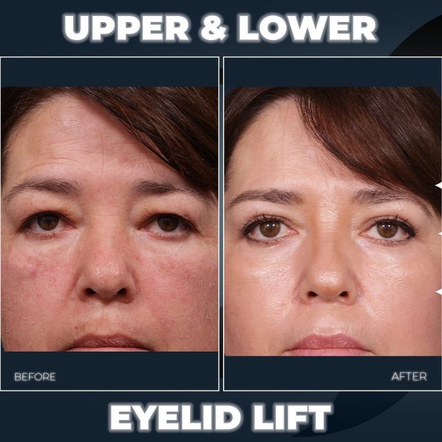 Upper & Lower Eyelid Lift 👀✨// #eyelidlift 

BENEFITS🌟 
🪄 Rejuvenated & Refreshed Appearance
🪄 Reduction in Swollen & Drooping Eyelids.
🪄 Enhanced Self-Confidence & Vitality.

✨Our patient, who is in her 50s, had eyelids that appeared swollen and droopy, making her look older and tired. There was noticeable loose skin around her eyes that hung over the natural creases of her eyelids, and she also had puffiness under her eyes, which added to her overall tired appearance.

✨To address these concerns, she opted for upper and lower blepharoplasty surgery, aimed at improving the appearance of her eyelids. During the 👀procedure, excess skin and fat were removed from both the upper and lower eyelids. This type of cosmetic surgery is typically done to reduce puffiness in the lower eyelids and can also improve vision by eliminating excess skin that obstructs the upper eyelids.

BOOK NOW | In-office or virtual appointments by sending your name, number, and email to the DM. 

📲 CALL US | questions regarding treatment: (310) 300-1779

📩Email: Info@drstoker.com

🛍 SHOP SKINCARE | Link in bio 🔗

COMMENT BELOW 🔽
.
.
.
.
#blepharoplasty #plasticsurgery #facelift #eyelidsurgery #eyelift#blepharoplastysurgeon  #eyelidrejuventation #upperblepharoplasty #upperbleph #uppereyelids #antiaging #eyes  #facialrejuvenation #facialplasticsurgery #lowerbleph #cosmeticsurgery #plasticsurgeon #surgery #beauty #skintightening #beforeandafter #aesthetic #maleplasticsurgery #drstoker #boardcertified #boardcertifiedplasticsurgeon #hollywood #beverlyhills