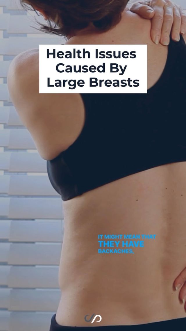 Is Breast Reduction Surgery For You? ✨🍒// #breastreduction 

What Are The Benefits? 💞
🍒Pain Relief 
🍒Enhanced Mobility
🍒Proportional Appearance 

✨Breast reduction surgery, or reduction mammoplasty, is a suitable option for female and male individuals with large breasts causing physical discomfort and impacting their quality of life. Common issues include back and neck pain, bra strap marks, fitting challenges in clothing, and limited physical activities like running. 

✨This surgery addresses such concerns and is also relevant for men experiencing gynecomastia, characterized by excess breast tissue or fat leading to a feminine chest appearance. The procedure involves addressing various factors like excess fat, glandular tissue, loose skin, and nipple prominence.

BOOK NOW | In-office or virtual appointments by sending your name, number, and email to the DM. 

📲 CALL US | questions regarding treatment: (310) 300-1779

📩Email: Info@drstoker.com

🛍 SHOP SKINCARE | Link in bio 🔗

COMMENT BELOW 🔽
.
.
.
.

#breastaugmentation #boobjob #breastimplants #gummybearimplants #breastenlargement #beforeandafter #breastsurgery #breastimplant #cosmeticsurgery #plasticsurgery #boobjobexpert #breastaugmentationexpert #boardcertified #boardcertifiedplasticsurgeon #mastopexy #breastaug #breastreconstruction #plasticsurgeon #breastlift #postop #postopsurgery #beforeandaftersurgery