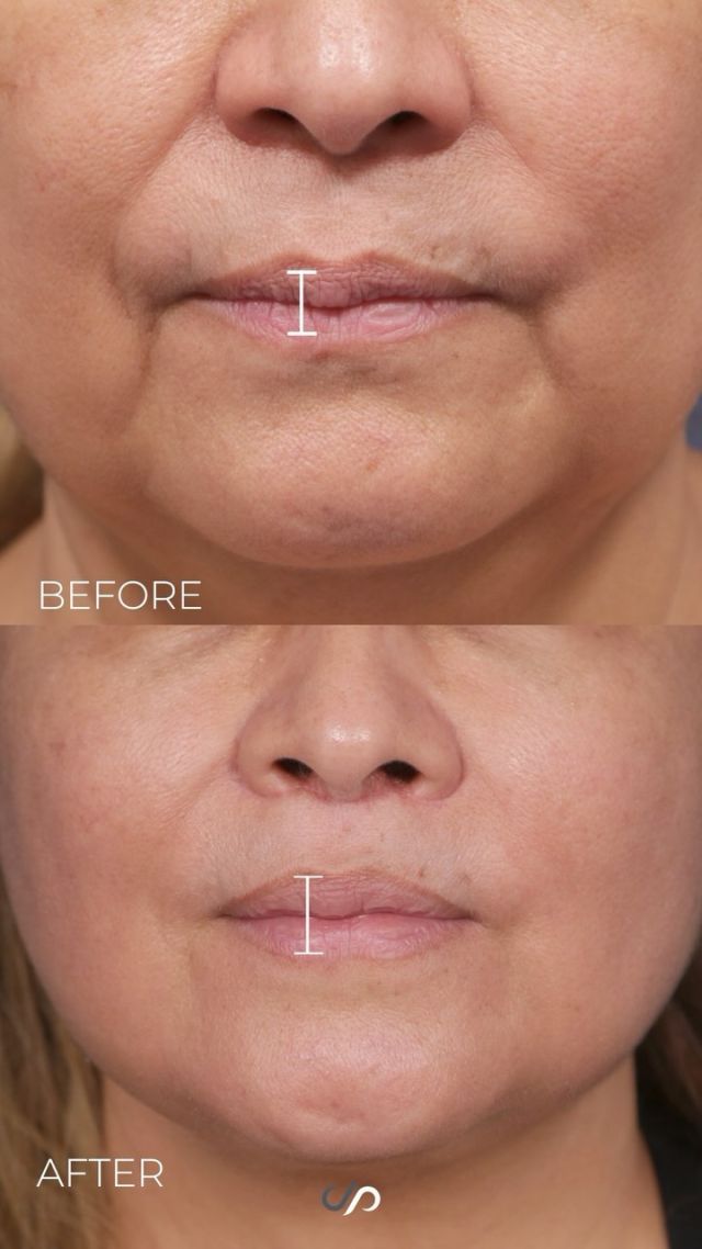 Upper Lip Lift // Buccal Fat Reduction 🥰✨#rejuvenation
 
RESULTS
✨Youth Lip Curvature 
✨ Improved Shape 
✨ Natural Appearance 

We rejuvenated our pretty patient with an upper lip lift and buccal fat pad reduction. She now has a much more youthful curvature and her upper teeth are now visible. We shortened the distance between her nose and lips which often can create an older look. Performing this procedure we managed to keep a beautiful natural look as well as enhance beauty.

BOOK NOW | in-office or virtual appointments by sending your name, number, and email to the DM.

📲 CALL US | questions regarding treatment: (310) 300-1779

🛍 SHOP SKINCARE | Link in bio 🔗

COMMENT BELOW ⬇️ 
.
.
.
.
#liplift #upperliplift #facelift #plasticsurgery #beauty #botox #antiaging #skincare #cosmeticsurgery #liposuction #plasticsurgeon #necklift #fillers #breastaugmentation #beforeandafter #blepharoplasty #surgery #aesthetics #facelifting #skintightening #filler #nonsurgicalfacelift #aesthetic #skin