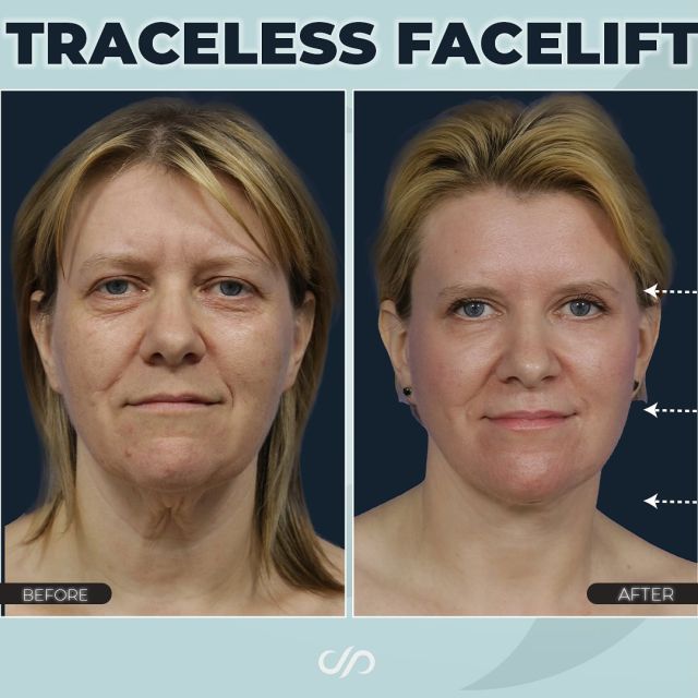Trust the Process // Traceless Facelift Recovery 🥰✨ // #facelift  #beforeandafter 

BENEFITS 🌟
💞 Skin Tightening
💞 Wrinkle Reduction
💞 Improved Skin Texture
💞 Enhanced Jawline and Neck Definition
💞 Brighter Eye Area

⏱️Patients frequently inquire about the recovery process for our traceless facelift. Typically, you can expect to take about one week off work, with most people feeling comfortable getting back to their routine within 10-14 days. Keep in mind that the specific type of facelift performed can impact your recovery time. Results usually shine brightest in 2-3 months, but if you’re considering a more complex procedure, it may take a bit longer. 

🙌It’s wise to schedule your facelift well ahead of any important events. Recovery can vary, especially if you’re having additional procedures like eyelid surgery, laser resurfacing, or chin implants. Even with smaller lifts, plan on taking at least ten days off before returning to your usual activities.

BOOK NOW | In-office or virtual appointments by sending your name, number, and email to the DM.

📲 CALL US | questions regarding treatment: (310) 300-1779

🛍 SHOP SKINCARE | Link in bio 🔗 

COMMENT BELOW 🔽
.
.
.
.
#tracelessfacelift #facelift #necklift #skincare #cheeklift #lowerfacelift #laserskinresurfacing #blepharoplasty #upperbleph #uppereyelid #eyelidsurgery  #co2 #chinaugmentation #skinrejuvenation #skintightening  #cosmeticsurgery #wrinkles  #surgery #rejuvenation #skin #plasticsurgeon #transformation #plasticsurgery