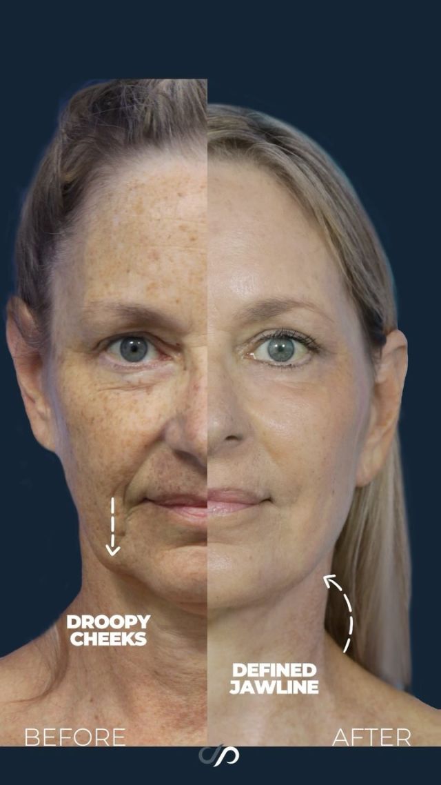 Traceless Facelift 🤯🔥 // #facelift 

OUTCOME 🙋‍♀️
💕Younger-Looking Appearance
💕Improved Skin Texture
💕Discreet Incisions 

Facelifts are designed to reverse signs of aging in the face that occur due to the loss of elasticity in the skin. The surgery tightens and lifts the skin of the face for optimal facial rejuvenation. Incisions are placed in discreet locations to go unnoticed, leaving no trace of a procedure. 

Our patients who undergo this procedure are given a new lease on life by turning the clock back. This procedure is often combined with CO2 laser resurfacing, which is ideal for stimulating collagen for firmer and youthful skin. 

👋BOOK NOW | in-office or virtual appointments by sending your name, number, and email to the DM. 

📲 CALL US | questions regarding treatment: (310) 300-1779

📩Email: Info@drstoker.com

🛍 SHOP SKINCARE | Link in bio 🔗

COMMENT BELOW 🔽
.
.
.
.
#rejuvenation #tracelessfacelift #faceliftexpert  #skincare #cheeklift #lowerfacelift #laserskinresurfacing #blepharoplasty #upperbleph #uppereyelid #eyelidsurgery  #co2 #chinaugmentation #skinrejuvenation #skintightening  #cosmeticsurgery #wrinkles  #surgery #rejuvenation #skin  #antiaging #plasticsurgeon #transformation #plasticsurgery