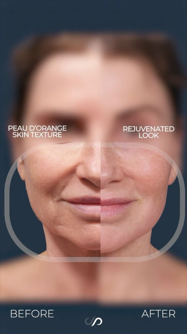 CO2 Laser Resurfacing ⚡️ // #facialrejuvenation 

✅RESULTS
✨Improved Skin Texture
✨Diminished Wrinkling 
✨Tightened Neck

🛠️The patient’s facial skin came to us with prominent signs of sun damage, including visible discoloration and pronounced wrinkling, suggesting prolonged sun exposure and significant skin damage. We performed CO2 laser resurfacing to address these issues. This advanced procedure stimulates collagen production, reduces wrinkles, and revitalizes the complexion, resulting in smoother, more youthful-looking skin with a renewed glow. 

👉If you’re seeking to reverse sun damage and achieve a more vibrant complexion, CO2 laser resurfacing offers effective rejuvenation and long-lasting results.

👋BOOK NOW | In-office or virtual appointments by sending your name, number, and email to the DM.

📲 CALL US | questions regarding treatment: (310) 300-1779

🛍 SHOP SKINCARE | Link in bio 🔗 

COMMENT BELOW 🔽
.
.
.
.
#tracelessfacelift #facelift #necklift #skincare #cheeklift #lowerfacelift #laserskinresurfacing #blepharoplasty #upperbleph #uppereyelid #eyelidsurgery  #co2laser #chinaugmentation #skinrejuvenation #skintightening  #cosmeticsurgery #wrinkles  #surgery #rejuvenation #skin #plasticsurgeon #transformation #plasticsurgery