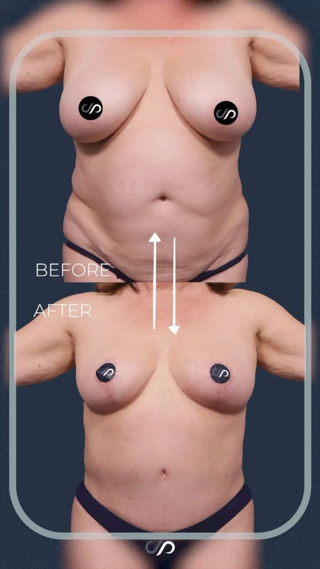 Mommy Makeover 🙆‍♀️👙 // #mommymakeover #lifechanging 

👋Take a look at these stunning outcomes. Her breasts are now beautifully perky after 430 grams were removed from each side, reducing her by two cup sizes. With an internal bra, she enjoys immediate fullness without excess skin. Check out the tightness in her abdominal muscles, eliminating previous laxity. Her belly button looks fantastic, and the scars are fading nicely, positioned low for bikini confidence. 

👉This mommy makeover, including breast surgery, tummy tuck, and 360-degree power-assisted liposuction, has delivered remarkable results.

Visit us at drstoker.com to learn more about our combination Mommy Makeover procedures!

BOOK NOW | In-office or virtual appointments by sending your name, number, and email to the DM. 

📲 CALL US | questions regarding treatment: (310) 300-1779

📩Email: Info@drstoker.com

🛍 SHOP SKINCARE | Link in bio 🔗

COMMENT BELOW 🔽
.
.
.
.
#skintightening #abdominoplasty #liposuction #bodytransformation #plasticsurgery #lowerbody #plasticsurgeon #cosmeticsurgery #surgery #bodycontouring #physique #weightloss #liposculpture #weightlosstransformation #beforeandafter #bodycontouring #recovery #recoverytime #downtime #body #drstoker #boardcertifiedplasticsurgeon #postopcare #bodyshaping #fitness