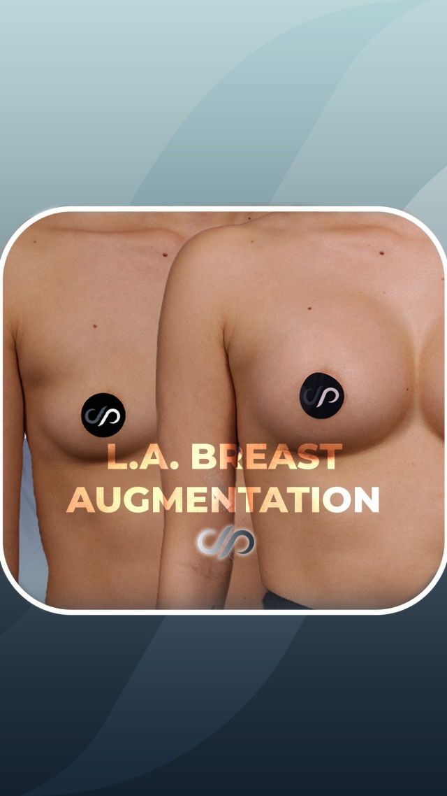 Breast Augmentation 🔥🍒 // #breastaugmentation #recovery

BENEFITS 👋 
🌟Minimal Downtime
🌟LA Natural Results
🌟Quick Return to Daily Life

Breast augmentation can be life-enhancing, boosting confidence and addressing size concerns. For minimal disruption, choose our rapid recovery approach with advanced techniques, reducing downtime and ensuring you can swiftly return to your daily activities while enjoying natural-looking results.

Visit our website, drstoker.com, to learn more about our breast augmentation procedures and determine which surgery is best for you. 

 BOOK NOW | In-office or virtual appointments by sending your name, number, and email to the DM. 

📲 CALL US | questions regarding treatment: (310) 300-1779

📩Email: Info@drstoker.com

🛍 SHOP SKINCARE | Link in bio 🔗

COMMENT BELOW 🔽 .
.
.
.
#breastaugmentation #boobjob #breastimplants #gummybearimplants #breastenlargement #beforeandafter #breastsurgery #breastimplant #cosmeticsurgery #plasticsurgery #boobjobexpert #breastaugmentationexpert #boardcertified #boardcertifiedplasticsurgeon #mastopexy #breastaug #breastreconstruction #plasticsurgeon #breastlift #postop #postopsurgery #beforeandaftersurgery