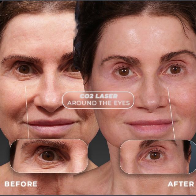 CO2 Laser Resurfacing // Eyes 👁️ ✨ // #eyerejuvenation 

✨Many of our patients desire a youthful eye appearance, but CO2 laser resurfacing can achieve dramatic results without surgery. This patient’s brow and under-eye areas are now wrinkle-free and smooth. We achieved a subtle brow lift effect and improved skin texture with fractional CO2 laser to compliment her Traceless Facelift.

👋BOOK NOW | In-office or virtual appointments by sending your name, number, and email to the DM. 

📲 CALL US | questions regarding treatment: (310) 300-1779

📩Email: Info@drstoker.com

🛍 SHOP SKINCARE | Link in bio 🔗

COMMENT BELOW 🔽
.
.
.
.
#co2 #laser #skinresurfacing #wrinkleremoval #facelift #necklift #skincare #laserskinresurfacing #skin #dermatology #fractionalco #blepharoplasty  #skinrejuvenation #skintightening  #cosmeticsurgery #wrinkles #surgery #rejuvenation #skin #plasticsurgeon #transformation #plasticsurgery