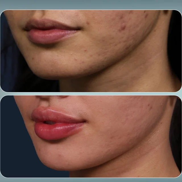 Lip Filler Enhancement 💋✨// #lipfiller #enhancement 

Why Lip Filler? 💞
👄Plump & Full Lips
👄Defined Cupid’s Bow
👄Symmetrical Smile

😍 Lip fillers are a key option for rejuvenation maintenance, perfect for those looking to enhance volume and achieve a plumper, more youthful appearance.

👋 BOOK NOW | in-office or virtual appointments by sending your name, number, and email to the DM. 

📲 CALL US | questions regarding treatment: (310) 300-1779

📩Email: Info@drstoker.com

🛍 SHOP SKINCARE | Link in bio 🔗

COMMENT BELOW 🔽
.
.
.
.
#lipfillerbeforeandafter #dermalfiller #cosmeticinjector #juvederm #restylanel #juvedermultra  #fillers #filler #lipflip #plumplips #lipaugmentation #lipfillers #lipenhancement #antiaging #aesthetics #lipgoals #lipenvy #skin #injectables #plasticsurgery #treatyoself #cheekfiller #lips #aestheticsexpert #selfcare #beforeandafter #skincareroutine