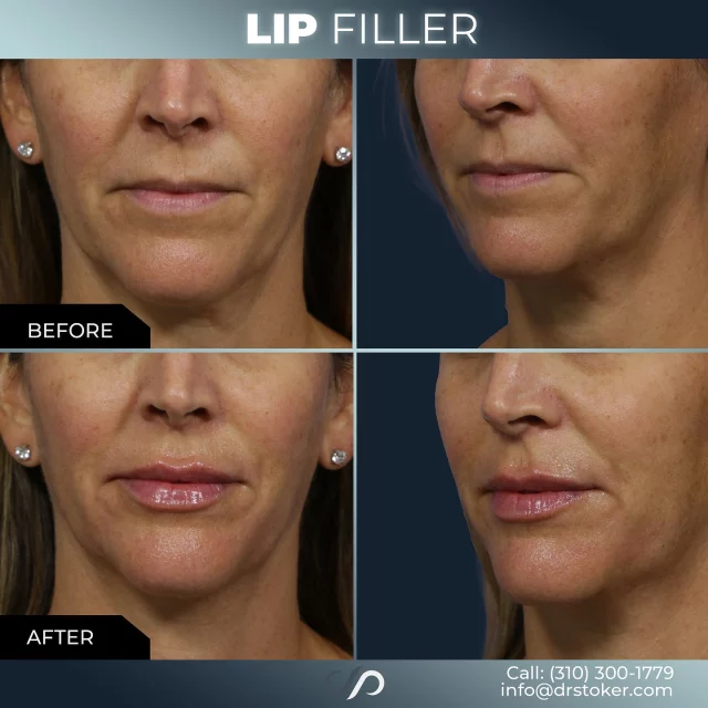 Lip Filler ✨💋 // #lipfiller #enhancement

RESULTS 💉👄 
✨Enhanced Volume & Definition 
✨Smoother, Wrinkle-Free Lips 
✨Natural-Looking Results

BONUS 🌟 If you want to tackle wrinkles and fine lines, Botox is a great option! It works by blocking nerve signals to reduce muscle movement and lessen the appearance of wrinkles.

Visit our website, drstoker.com, to view striking before and after photos and discover our full range of rejuvenation services. Start your journey to a more youthful look today!

BOOK NOW | in-office or virtual appointments by sending your name, number, and email to the DM. 

📲 CALL US | questions regarding treatment: (310) 300-1779

📩Email: Info@drstoker.com

🛍 SHOP SKINCARE | Link in bio 🔗

COMMENT BELOW 🔽
.
.
.
.
#lipfillerbeforeandafter #dermalfiller #cosmeticinjector #juvederm #restylanel #juvedermultra  #fillers #filler #lipflip #plumplips #lipaugmentation #lipfillers #lipenhancement #antiaging #aesthetics #lipgoals #lipenvy #skin #injectables #plasticsurgery #cheekfiller #lips #aestheticsexpert #selfcare #beforeandafter #skincareroutine