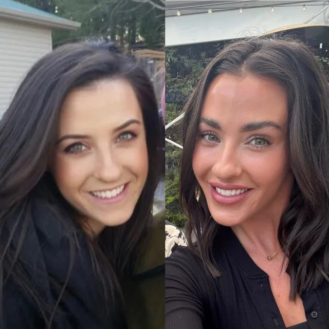 10 years of working as an aesthetic injector and I want you to see that it’s not as scary as Reddit can make it seem 😊 

Look at baby Brittany over there on the left! In the midst of PA school and not a drop of Botox (and many other things 🤣)

My advice? Build a trusting relationship with an injector who’s in it for the long-haul with you and prioritizes long term outcomes over short term fixes and trends. 

If you have questions about any of my treatments comment below or send me a message, I’m happy to answer!
.
.
.
#dermalfiller #botox #beauty #antiaging #aesthetics #fillers #undereyefiller #dermalfiller #medicalspa #juvederm #skin #lipfiller #injectables #plasticsurgery #facial #cheekfiller #lips #esthetician #aestheticsexpert #facials #dermalfillers #selfcare #microneedling #dysport #bodycontouring #restylane #laser #skincareroutine