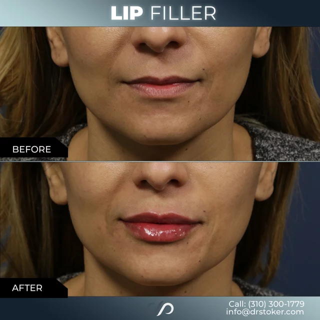 Lip Filler 👄✨// #lipfiller #enhancement

✨Instant Results
✨Non-Invasive
✨Customizable 

❣️ Lip fillers are a popular, non-surgical solution for enhancing the appearance of your lips. Using hyaluronic acid-based injectables, this treatment adds volume, defines shape, and restores symmetry to your lips for a fuller, youthful look.

✅ Visit our website, drstoker.com, to view striking before and after photos and discover our full range of rejuvenation services. Start your journey to a more youthful look today!

👋 BOOK NOW | in-office or virtual appointments by sending your name, number, and email to the DM. 

📲 CALL US | questions regarding treatment: (310) 300-1779

📩Email: Info@drstoker.com

🛍 SHOP SKINCARE | Link in bio 🔗

COMMENT BELOW 🔽
.
.
.
.
#lipfillerbeforeandafter #dermalfiller #cosmeticinjector #juvederm #restylanel #juvedermultra  #fillers #filler #lipflip #plumplips #lipaugmentation #lipfillers #lipenhancement #antiaging #aesthetics #lipgoals #lipenvy #skin #injectables #plasticsurgery #cheekfiller #lips #aestheticsexpert #selfcare #beforeandafter #skincareroutine