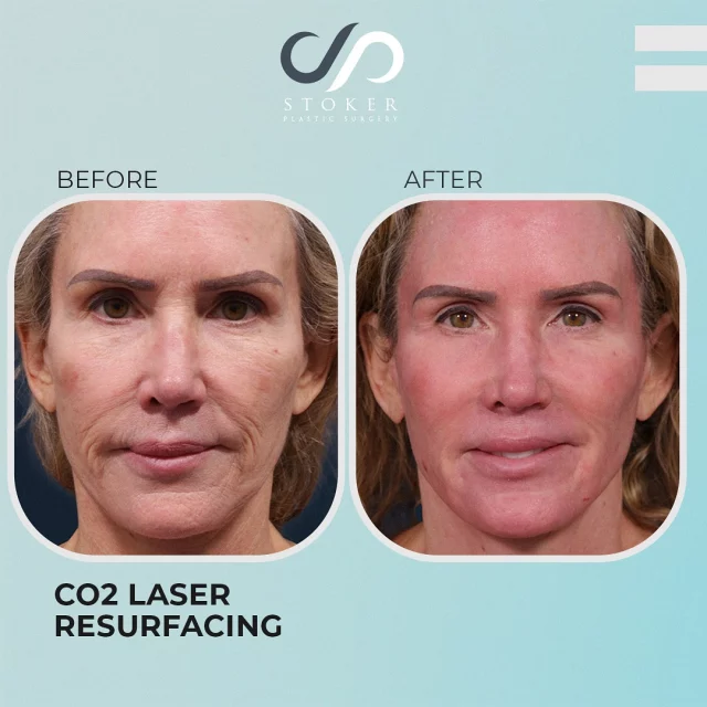 Early Results - CO2 Laser Skin Resurfacing 👩 ✨ // #facialrejuvenation 

RESULTS ✨
✅Diminished Wrinkles
✅Sunspot Correction
✅Youthful Appearance

🪄 This patient showed significant sun damage, including deep wrinkles, discoloration, and dryness. CO2 Laser Resurfacing was used to reduce wrinkles and sunspots, resulting in smoother, more rejuvenated skin.

👋BOOK NOW | In-office or virtual appointments by sending your name, number, and email to the DM. 

📲 CALL US | questions regarding treatment: (310) 300-1779

📩Email: Info@drstoker.com

🛍 SHOP SKINCARE | Link in bio 🔗

COMMENT BELOW 🔽
.
.
.
.
#co2 #laser #skinresurfacing #wrinkleremoval #facelift #necklift #skincare #laserskinresurfacing #skin #dermatology #fractionalco #blepharoplasty  #skinrejuvenation #skintightening  #cosmeticsurgery #wrinkles #surgery #rejuvenation #skin #plasticsurgeon #transformation #plasticsurgery