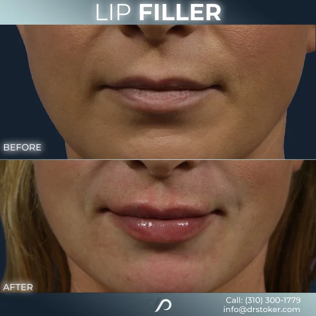 Lip Filler 👄✨// #lipfiller #enhancement

✨Instant Results
✨Non-Invasive
✨Customizable 

💕 Lip filler doesn’t have to be dramatic or unnatural. Results depend on the type of filler used and the amount injected. Some fillers are designed to add subtle hydration and smoothness, while others are used to build volume and shape. As lips age, they lose structure and moisture, just like other areas of the face. 

💕Restoring these qualities can enhance a youthful appearance without overcorrection. A personalized approach is key, so it’s important to discuss your goals and options with a qualified injector.

✅ Visit our website, drstoker.com, to view striking before and after photos and discover our full range of rejuvenation services. Start your journey to a more youthful look today!

👋 BOOK NOW | in-office or virtual appointments by sending your name, number, and email to the DM. 

📲 CALL US | questions regarding treatment: (310) 300-1779

📩Email: Info@drstoker.com

🛍 SHOP SKINCARE | Link in bio 🔗

COMMENT BELOW 🔽
.
.
.
.
#lipfillerbeforeandafter #dermalfiller #cosmeticinjector #juvederm #restylanel #juvedermultra  #fillers #filler #lipflip #plumplips #lipaugmentation #lipfillers #lipenhancement #antiaging #aesthetics #lipgoals #lipenvy #skin #injectables #plasticsurgery #cheekfiller #lips #aestheticsexpert #selfcare #beforeandafter #skincareroutine