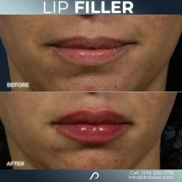 Lip Filler Rejuvenation 👄✨// #lipfiller #enhancement

💕 Lip fillers are a minimally invasive treatment that enhances lip volume, shape, and symmetry using hyaluronic acid-based injectables. The procedure provides immediate results with little downtime, improving lip contours and stimulating collagen production for long-lasting, natural-looking effects.

✅ Visit our website, drstoker.com, to view striking before and after photos and discover our full range of rejuvenation services. Start your journey to a more youthful look today!

👋 BOOK NOW | in-office or virtual appointments by sending your name, number, and email to the DM. 

📲 CALL US | questions regarding treatment: (310) 300-1779

📩Email: Info@drstoker.com

🛍 SHOP SKINCARE | Link in bio 🔗

COMMENT BELOW 🔽
.
.
.
.
#lipfillerbeforeandafter #dermalfiller #cosmeticinjector #juvederm #restylanel #juvedermultra  #fillers #filler #lipflip #plumplips #lipaugmentation #lipfillers #lipenhancement #antiaging #aesthetics #lipgoals #lipenvy #skin #injectables #plasticsurgery #cheekfiller #lips #aestheticsexpert #selfcare #beforeandafter #skincareroutine