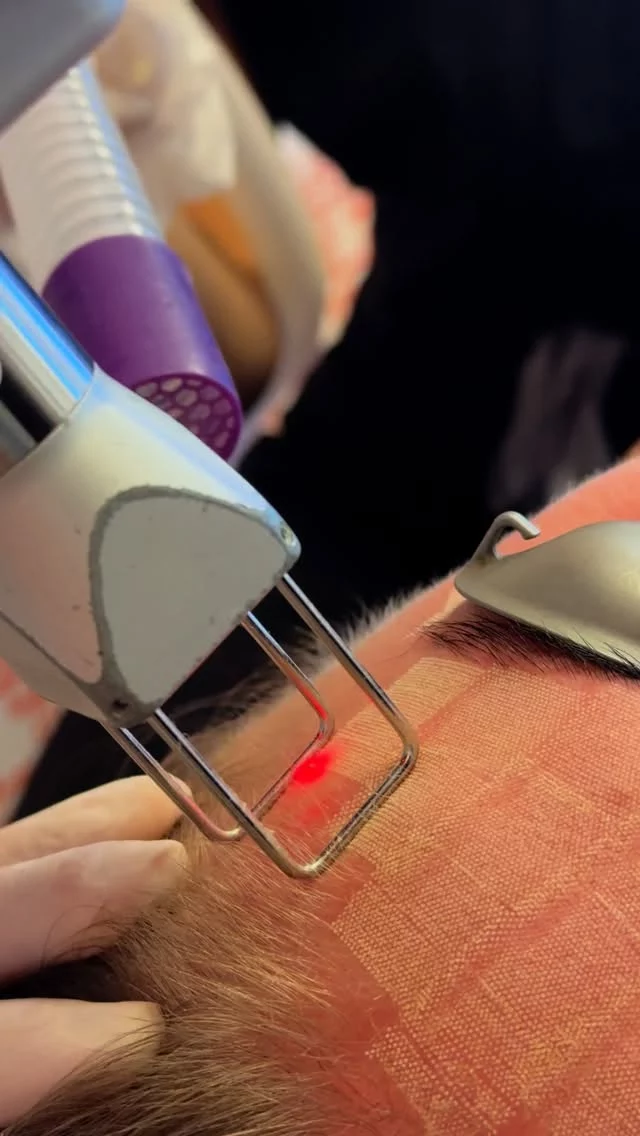 CO2 Laser Skin Resurfacing ✨⚡️⚡️ // #rejuvenation 

🌟 CO2 laser resurfacing offers a range of benefits by targeting the skin’s surface to promote collagen production and improve overall texture. By gently removing thin layers of damaged skin, this treatment helps reduce the appearance of acne scars, sun damage, and fine lines. 

🌟 It is especially effective on the face, neck, and chest, making it a powerful option for full skin rejuvenation.

 Visit us at drstoker.com, to view the before and afters of our amazing patients as well as learn more about this procedure. 

📲 CALL US | questions regarding treatment: (310) 300-1779

🛍 SHOP SKINCARE | Link in bio 🔗 
.
.
.
.
#aesthetics #co2laser #co2 #laserresurfacing #botox #filler #fillerlips #injectables #injector #skin #juvederm #lips #relatable #skincare #antiaging