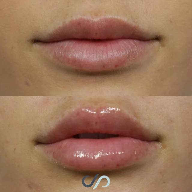 Lip Filler ✨💋✨// #lipfiller #enhancement

👄 Filler can hydrate, smooth, or restore lost definition—not just add volume. As lips age, they lose structure and moisture, which filler can gently enhance.

📌 With the right product and technique, results look natural and feel personalized. A skilled injector will tailor the approach to your goals.

✅ Visit our website, drstoker.com, to view striking before and after photos and discover our full range of rejuvenation services. Start your journey to a more youthful look today!

👋 BOOK NOW | in-office or virtual appointments by sending your name, number, and email to the DM. 

📲 CALL US | questions regarding treatment: (310) 300-1779

📩Email: Info@drstoker.com

🛍 SHOP SKINCARE | Link in bio 🔗

COMMENT BELOW 🔽
.
.
.
.
#lipfillerbeforeandafter #dermalfiller #cosmeticinjector #juvederm #restylanel #juvedermultra  #fillers #filler #lipflip #plumplips #lipaugmentation #lipfillers #lipenhancement #antiaging #aesthetics #lipgoals #lipenvy #skin #injectables #plasticsurgery #cheekfiller #lips #aestheticsexpert #selfcare #beforeandafter #skincareroutine